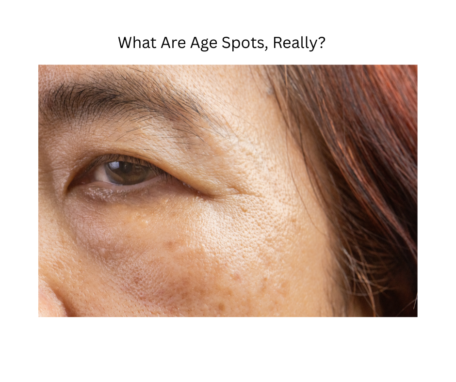 What Causes Age Spots, And 5 Proven Ways to Fade Them Naturally