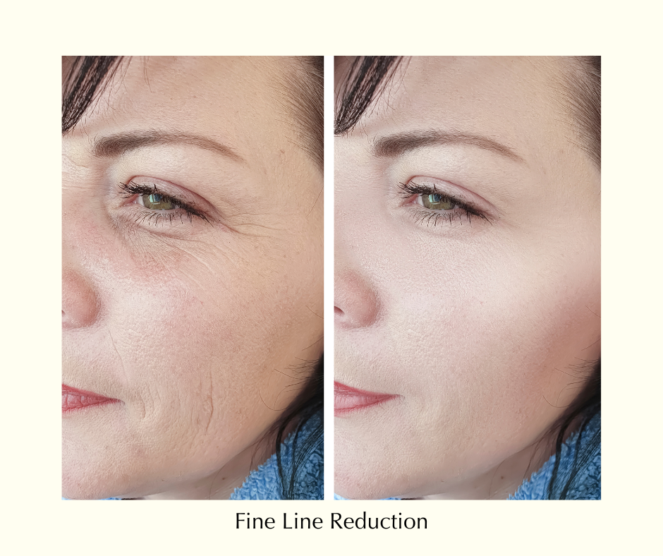 Fine Lines & Wrinkles