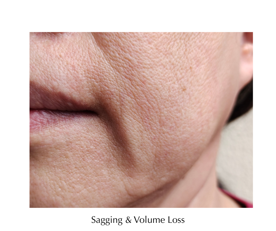 Sagging & Volume Loss