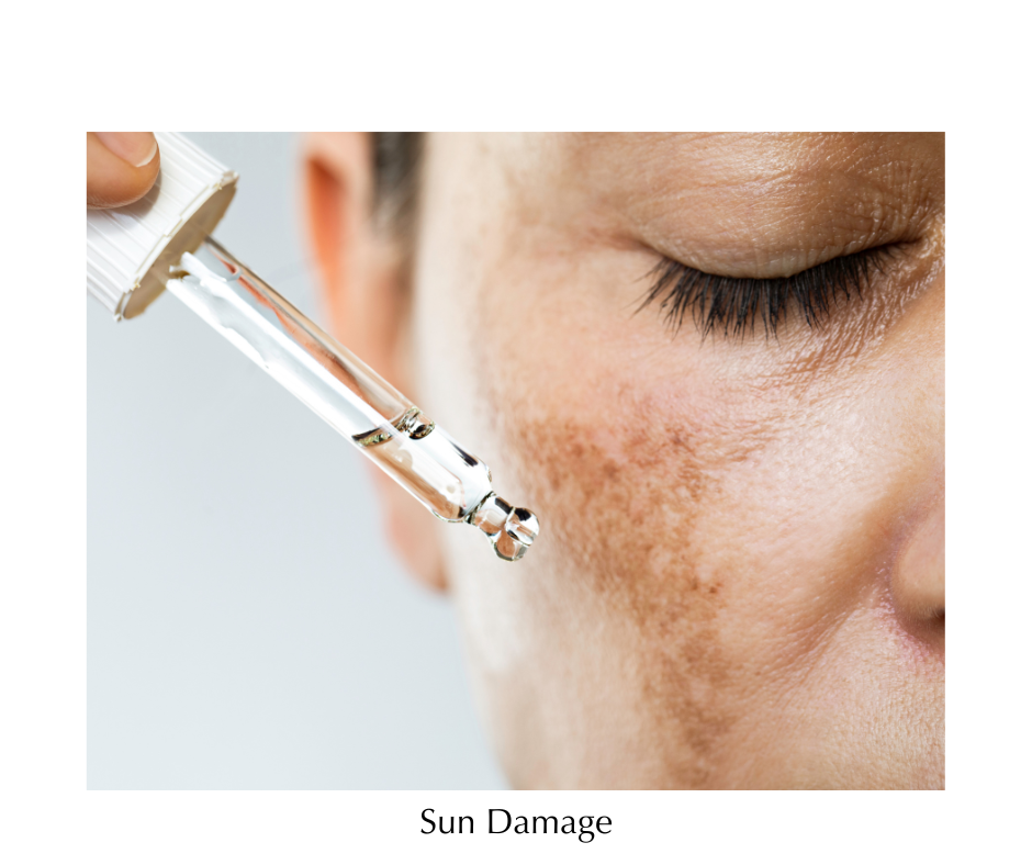 Sun Damage/Hyperpigmentation